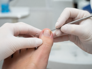 Ingrown Toenail Treatment