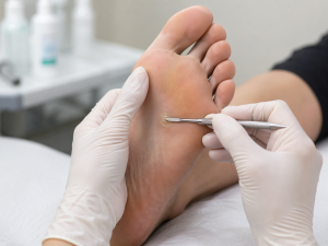 Verrucae Treatment